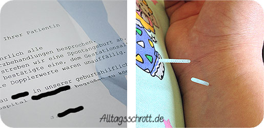 Akkupunktur - Nadeln im Arm - Befund vom Arzt - spontane Geburt angestrebt