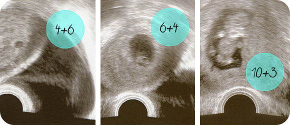 Ultraschall vom Minibaby